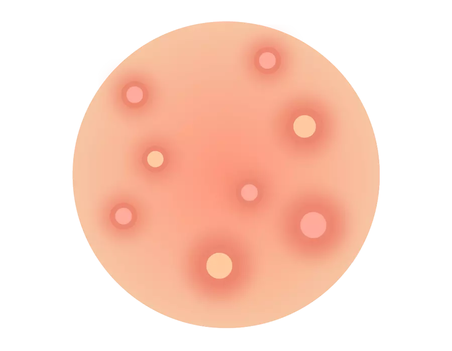 Acne dermatologic treatment in Idaho Falls