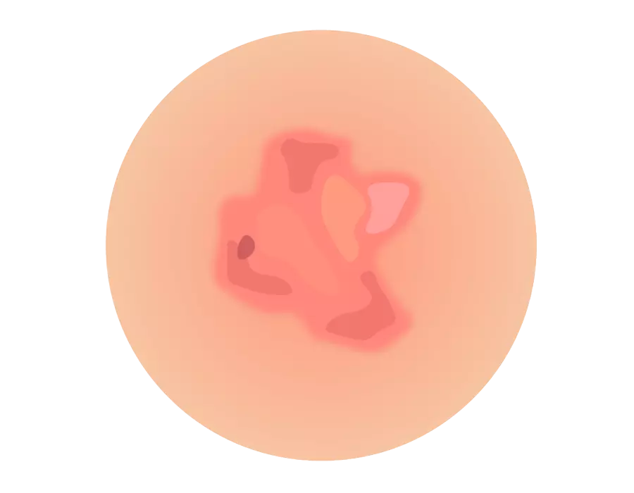 Acne dermatologic treatment in Idaho Falls