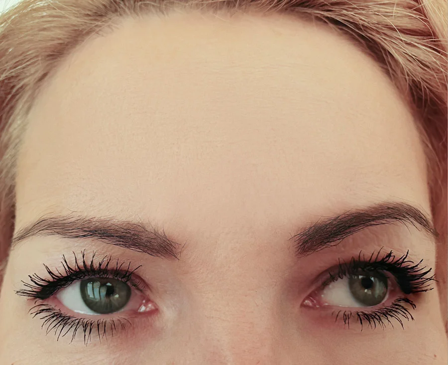 After Botox dermatologic treatment in Idaho Falls