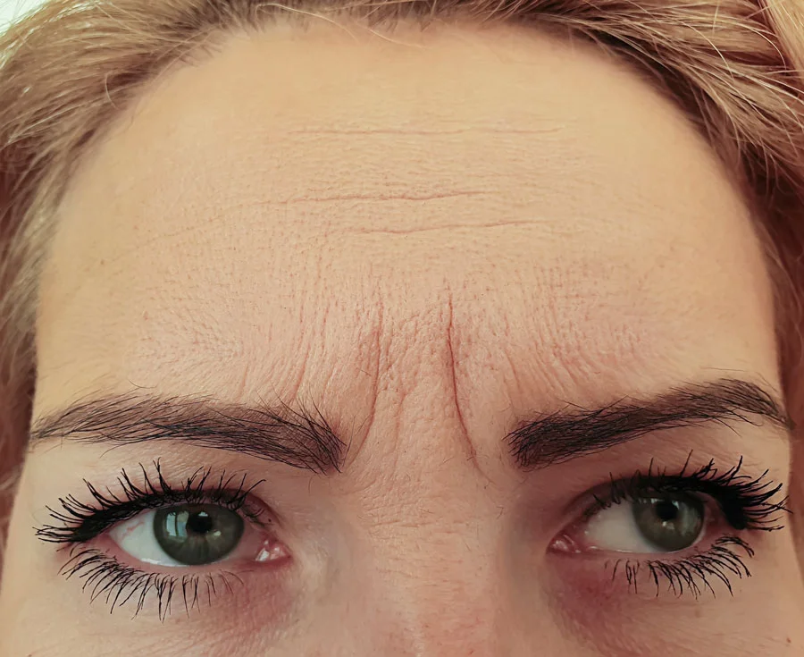 Before Botox dermatologic treatment in Idaho Falls