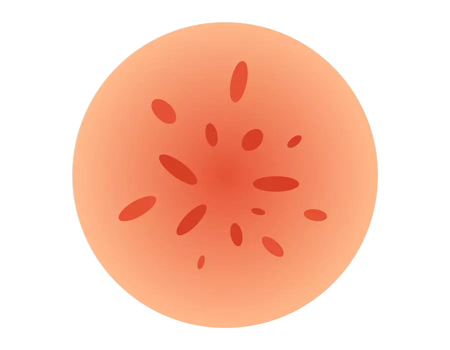 Acne dermatologic treatment in Idaho Falls