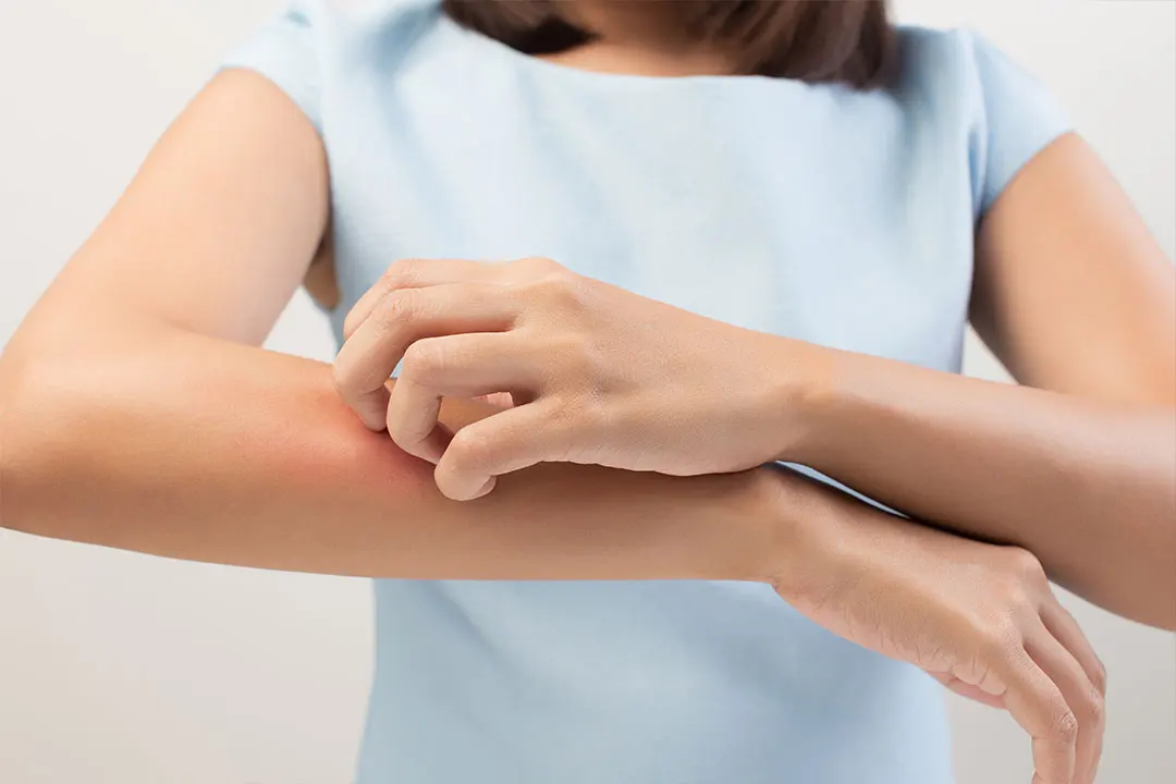 Eczema dermatologic treatment in Idaho Falls