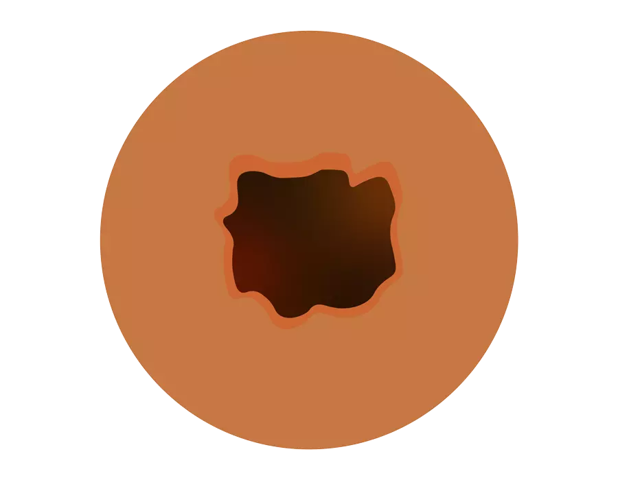 Acne dermatologic treatment in Idaho Falls