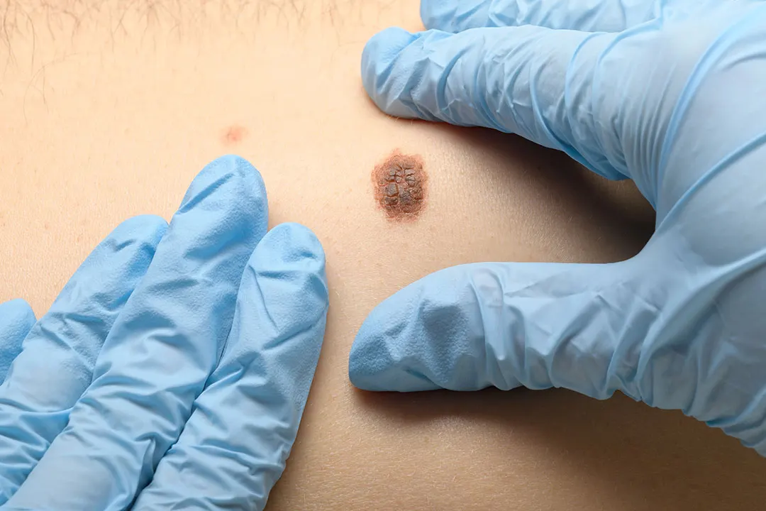 Melanoma dermatologic treatment in Idaho Falls
