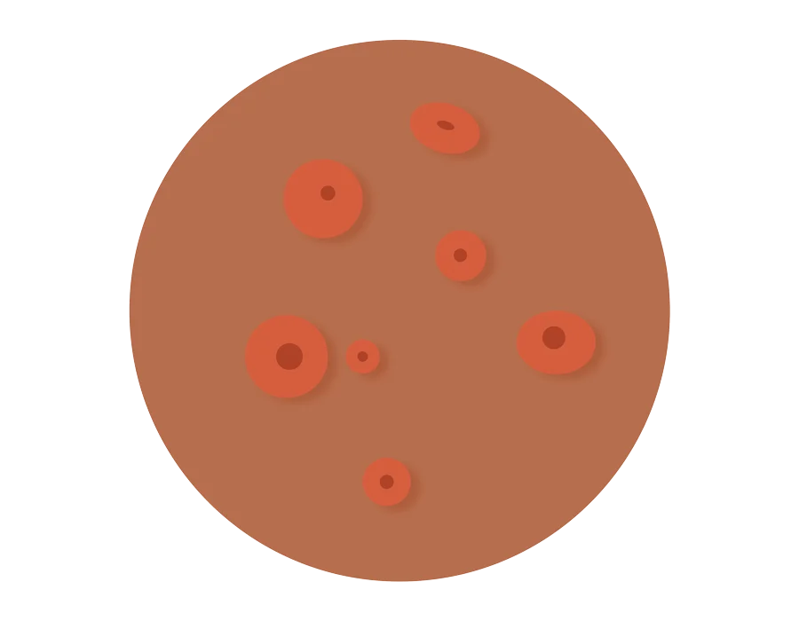 Molluscum dermatologic treatment in Idaho Falls