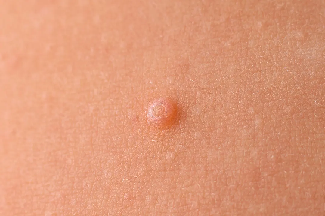 Molluscum contagiosum dermatologic treatment in Idaho Falls