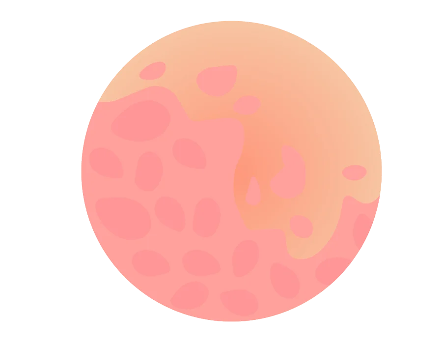 Psoriasis dermatologic treatment in Idaho Falls