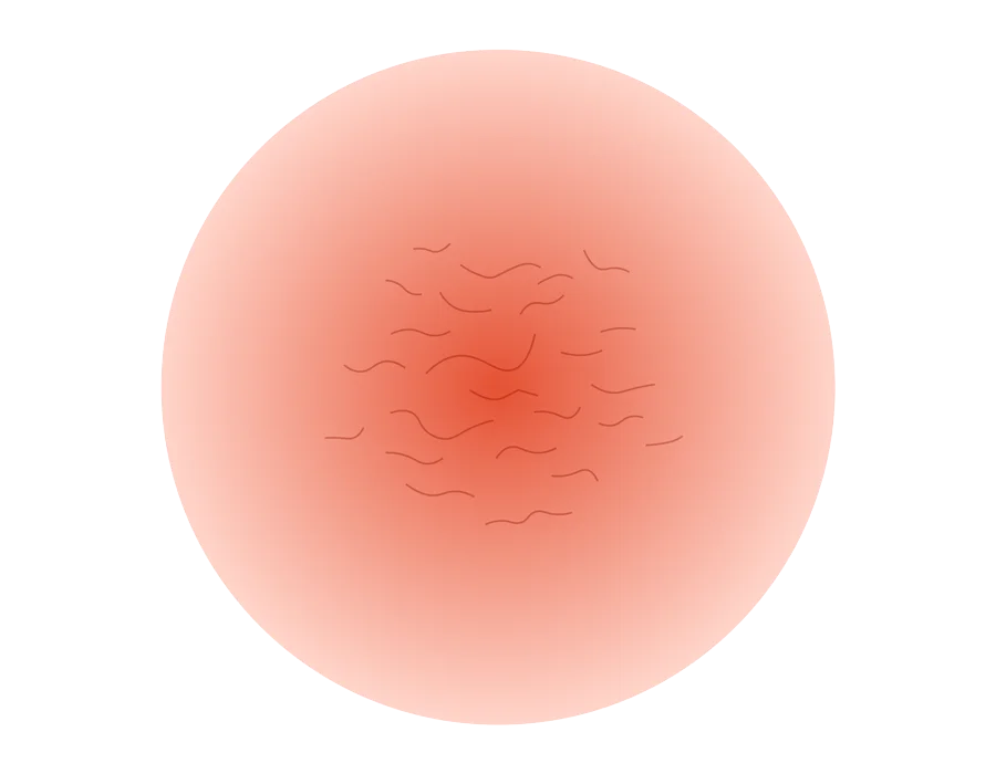 Rosacea dermatologic treatment in Idaho Falls