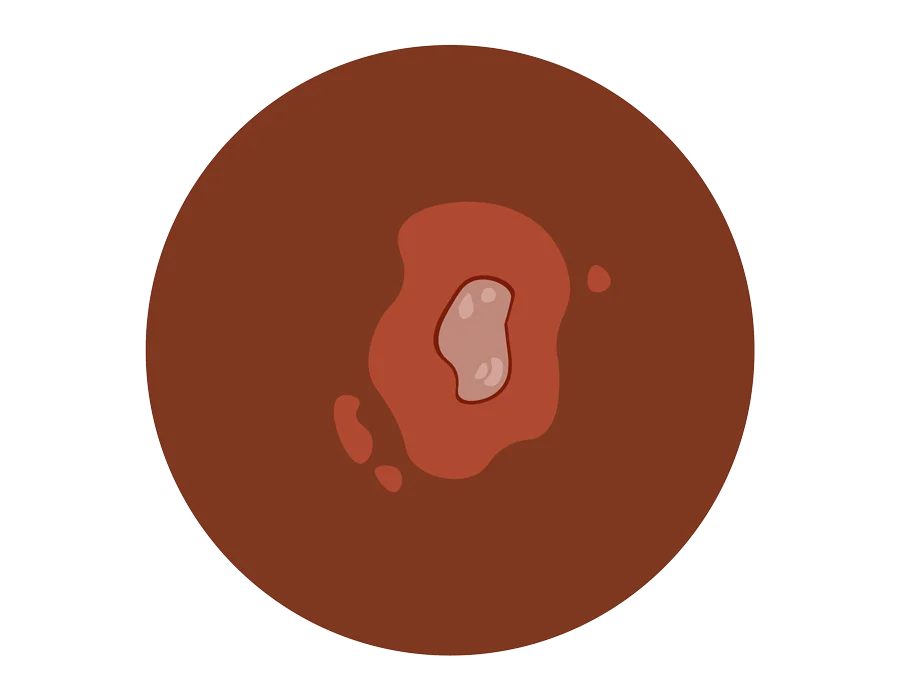 Squamous Cell Carcinoma dermatologic treatment in Idaho Falls