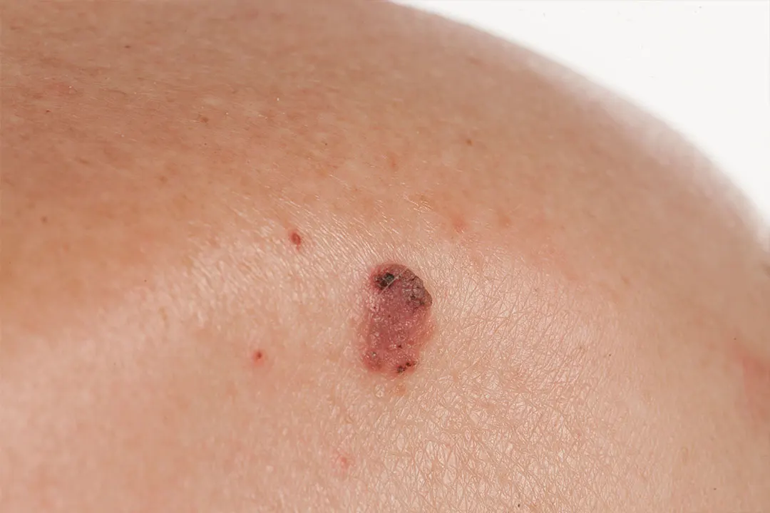 Squamous Cell Carcinoma dermatologic treatment in Idaho Falls